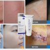 kem trị sẹo scar esthetique có tốt không