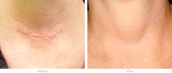 miếng dán silicon scar fx review từ người dùng miếng dán silicon scar fx review từ người dùng